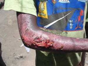 The wounds that Patrick faces twice a week on his visits to see the children
